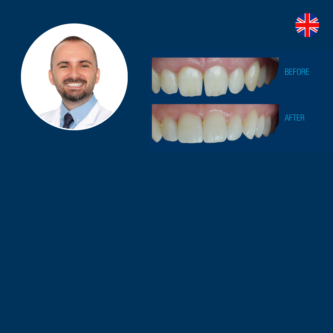 Diastema Closure CompoArt